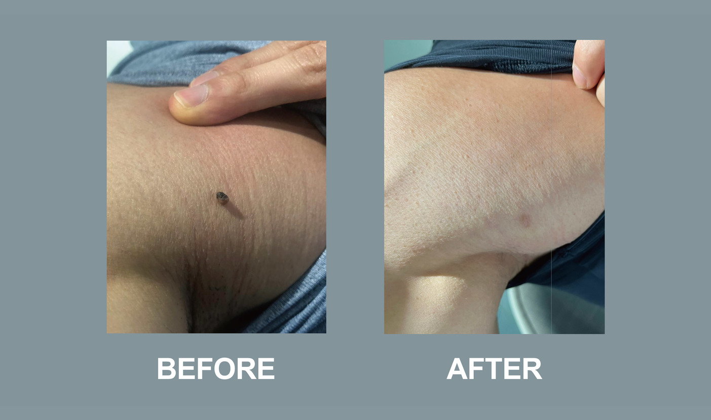 Mole Befroe and after-02