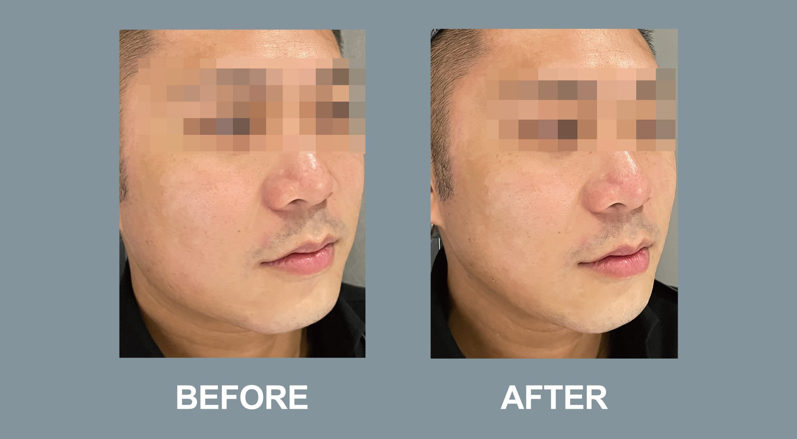 Tightening Befroe and after desktop-02